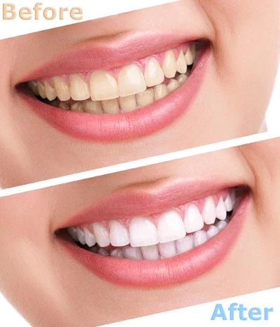 freshly whitened smile thanks to services from Penterson & Booth Family and Cosmetic Dentistry